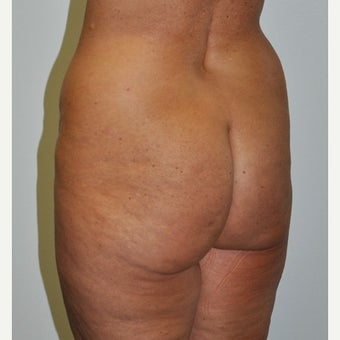 45-54 year old woman treated with Brazilian Butt Lift before 2677661