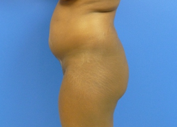 Brazilian Butt lift via fat transfer 916734