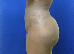 Brazilian Butt lift via fat transfer 916734
