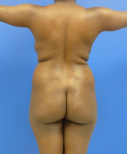 Brazilian Butt lift via fat transfer before 916734