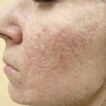 26 year old man with acne scars treated with RecoSMA after 2974589