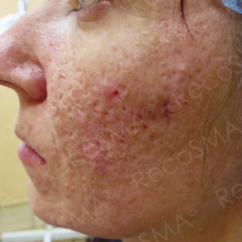 26 year old man with acne scars treated with RecoSMA before 2974589