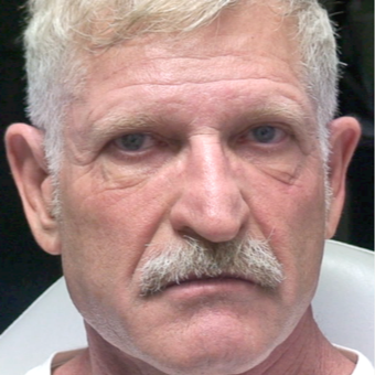 55-64 year old man treated with Injectable Fillers after 3176467