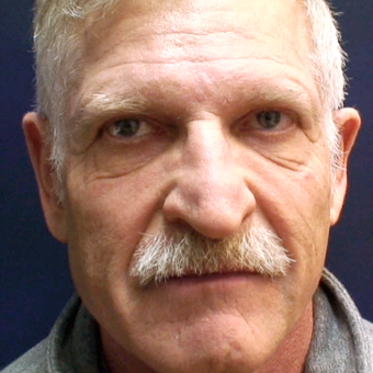 55-64 year old man treated with Injectable Fillers before 3176467