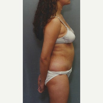 42 year old woman treated with Liposuction of her Abdomen after 1663366