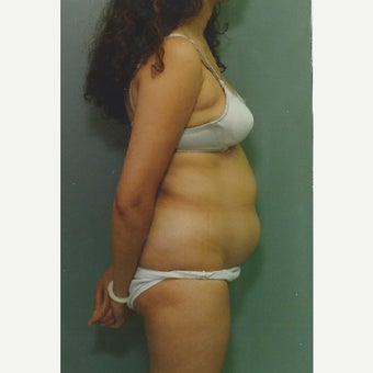 42 year old woman treated with Liposuction of her Abdomen before 1663366