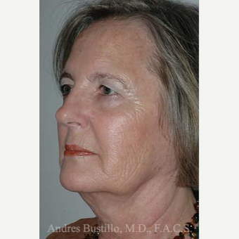 61 year old woman treated with Facelift before 3486245