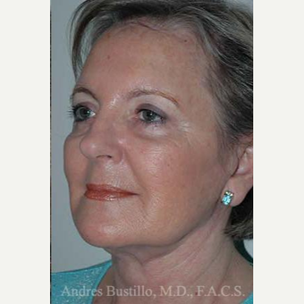 61 year old woman treated with Facelift after 3486245
