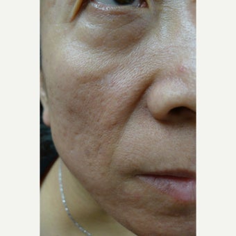 55-64 year old woman treated with Juvederm before 1551734