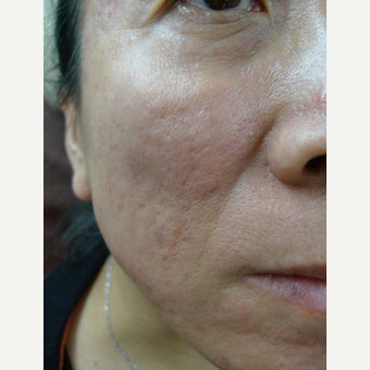 55-64 year old woman treated with Juvederm after 1551734