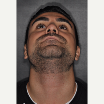 18-24 year old man treated with Rhinoplasty 6 weeks post-op after 3500142