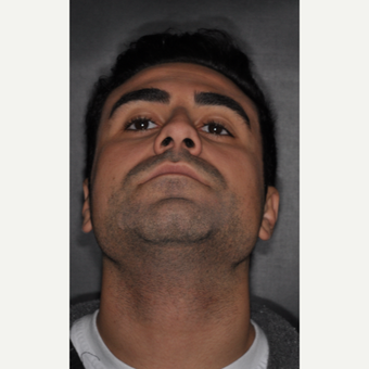 18-24 year old man treated with Rhinoplasty 6 weeks post-op before 3500142