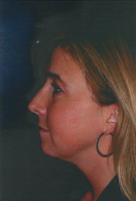 Chin Augmentation 911587