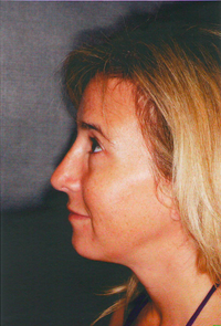 Chin Augmentation 911587