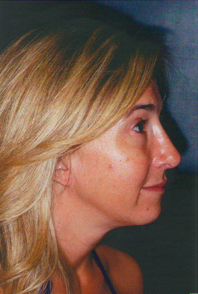 Chin Augmentation after 911587