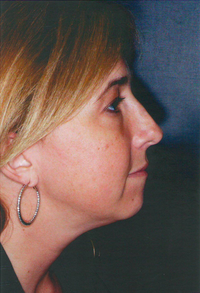 Chin Augmentation before 911587
