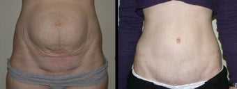 Diastasis Recti Repair before 1272155