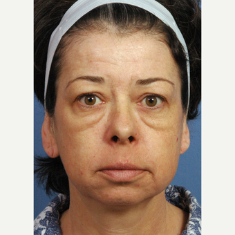 45-54 year old woman treated with Facelift before 3658176