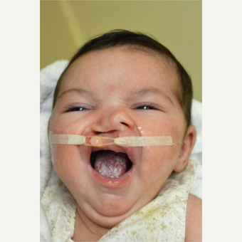 17 or under year old woman treated with Cleft Lip And Palate Repair before 3226507