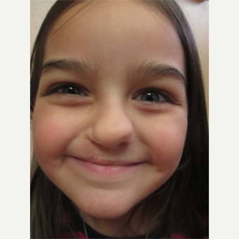 17 or under year old woman treated with Cleft Lip And Palate Repair after 3226507