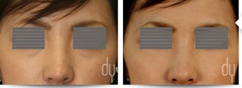 28 year old female treated for lower eyelid bags and prominent tear troughs. before 824645