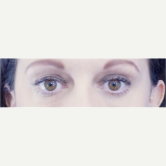 35-44 year old woman treated with Eye Bags Treatment after 3698472
