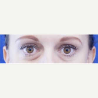 35-44 year old woman treated with Eye Bags Treatment before 3698472