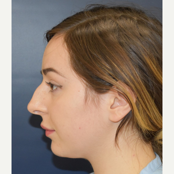 18-24 year old woman treated with Rhinoplasty before 3503422