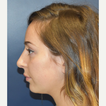 18-24 year old woman treated with Rhinoplasty after 3503422