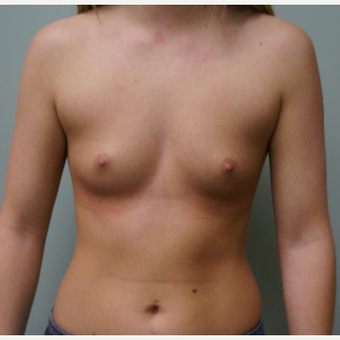 Breast Augmentation before 3453930