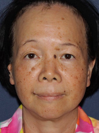50 year old Asian female treated for brown spots and age spots before 1058142