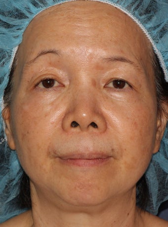 50 year old Asian female treated for brown spots and age spots after 1058142