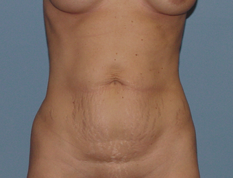 Abdominoplasty (tummy tuck) in the thin patient before 845707