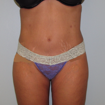 45-54 year old woman treated with Liposuction after 3009573