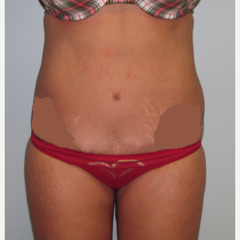 45-54 year old woman treated with Liposuction before 3009573