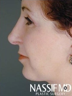 Female Primary Rhinoplasty after 958886