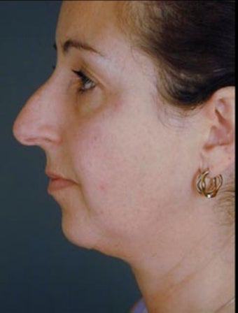 Female Primary Rhinoplasty before 958886