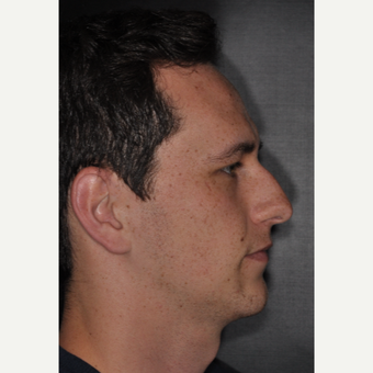 18-24 year old male treated with Septoplasty 6 weeks post-op before 3499641