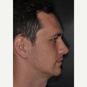 18-24 year old male treated with Septoplasty 6 weeks post-op after 3499641