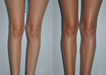 Calf Implants before 1111927