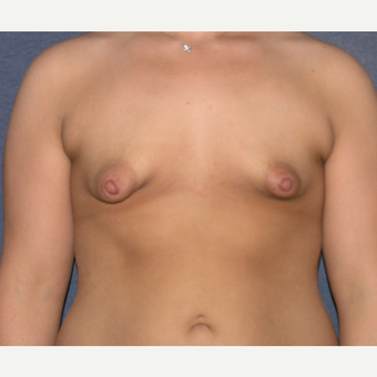 18-24 year old woman treated with Nipple Surgery before 3455462