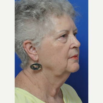 65-74 year old woman treated with Facelift before 3439037