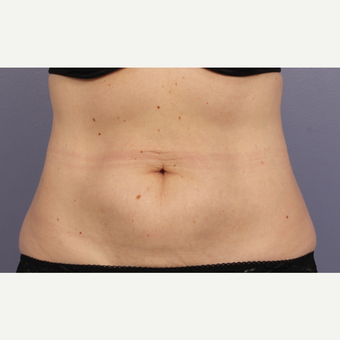 45-54 year old woman treated with CoolSculpting after 3710995
