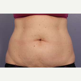 45-54 year old woman treated with CoolSculpting before 3710995
