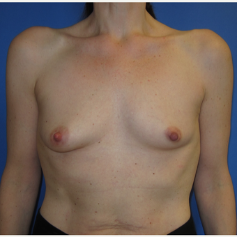 45-54 year old woman treated with Breast Augmentation (R. 286cc, L. 304cc) before 3309878