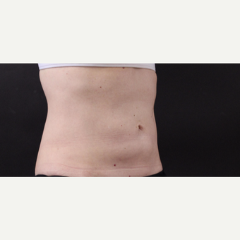 49 year old woman treated with CoolSculpting after 3630300