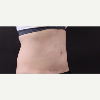 49 year old woman treated with CoolSculpting before 3630300