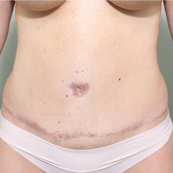 35-44 year old woman treated with Tummy Tuck after 3069749