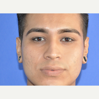 18-24 year old man treated with Restylane after 3225687