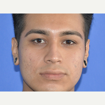 18-24 year old man treated with Restylane before 3225687
